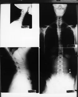 Spinal x-rays: cervical and full-spine views